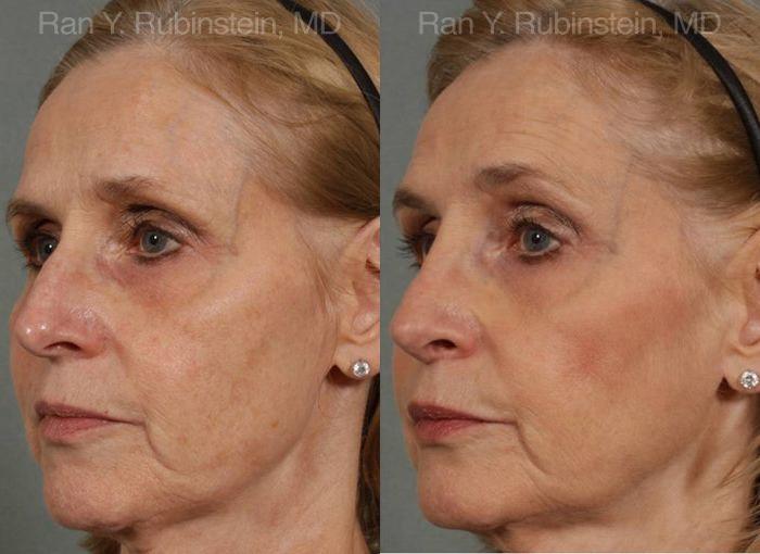 Rhinoplasty Before and After Photos in Montvale, NJ, Patient 13067