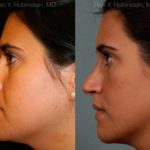Rhinoplasty Before and After Photos in Montvale, NJ, Patient 13084