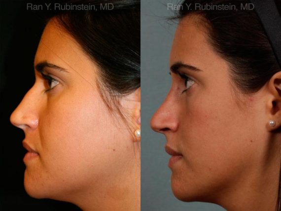 Rhinoplasty Before and After Photos in Montvale, NJ, Patient 13084