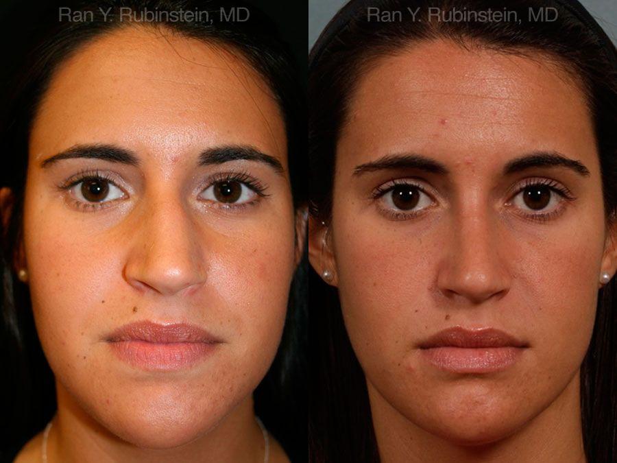 Rhinoplasty Before and After Photos in Montvale, NJ, Patient 13084