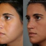 Rhinoplasty Before and After Photos in Montvale, NJ, Patient 13084