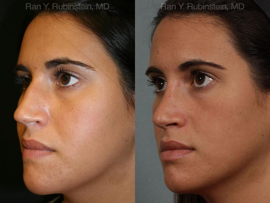 Rhinoplasty Before and After Photos in Montvale, NJ, Patient 13084