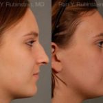 Rhinoplasty Before and After Photos in Montvale, NJ, Patient 13091