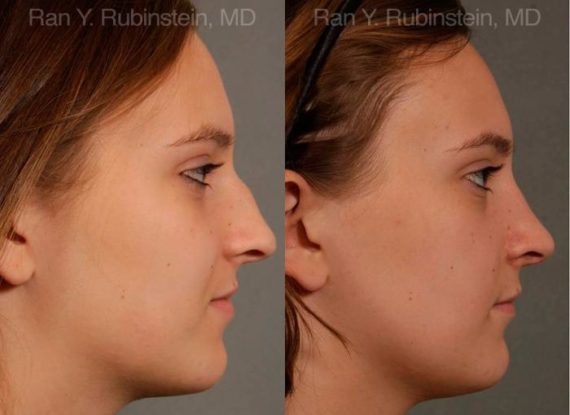 Rhinoplasty Before and After Photos in Montvale, NJ, Patient 13091