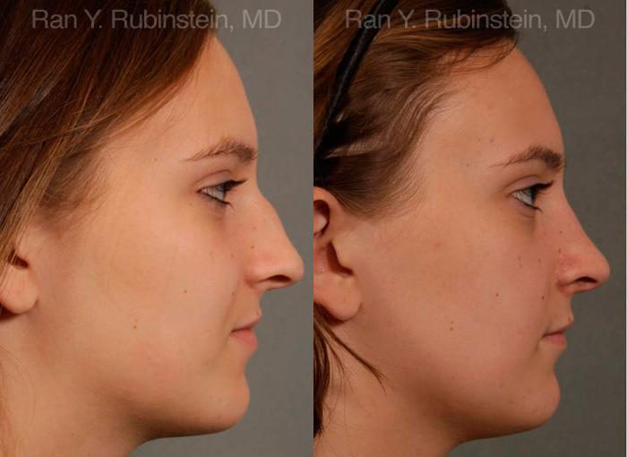 Rhinoplasty Before and After Photos in Montvale, NJ, Patient 13091