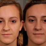 Rhinoplasty Before and After Photos in Montvale, NJ, Patient 13091