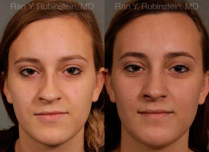 Rhinoplasty Before and After Photos in Montvale, NJ, Patient 13091