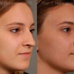 Rhinoplasty Before and After Photos in Montvale, NJ, Patient 13091