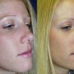 Rhinoplasty Before and After Photos in Montvale, NJ, Patient 13098