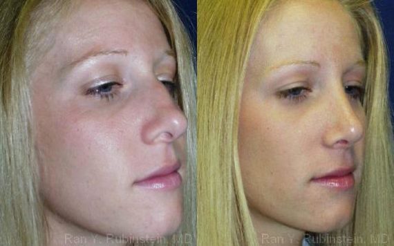 Rhinoplasty Before and After Photos in Montvale, NJ, Patient 13098