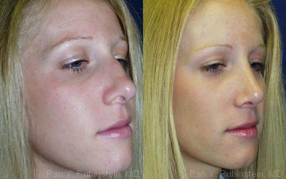 Rhinoplasty Before and After Photos in Montvale, NJ, Patient 13098