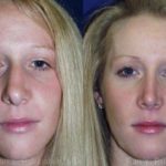 Rhinoplasty Before and After Photos in Montvale, NJ, Patient 13098