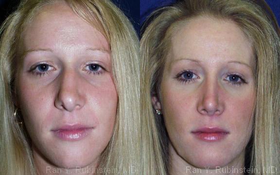 Rhinoplasty Before and After Photos in Montvale, NJ, Patient 13098