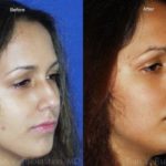 Rhinoplasty Before and After Photos in Montvale, NJ, Patient 13103