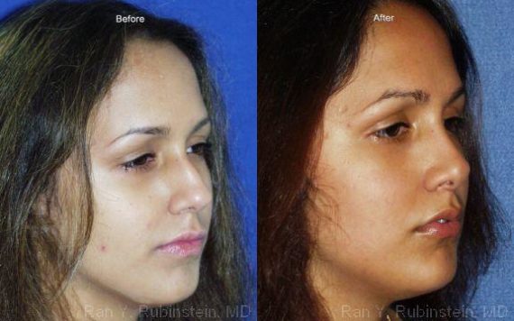 Rhinoplasty Before and After Photos in Montvale, NJ, Patient 13103