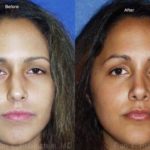 Rhinoplasty Before and After Photos in Montvale, NJ, Patient 13103