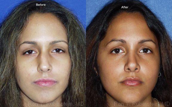 Rhinoplasty Before and After Photos in Montvale, NJ, Patient 13103