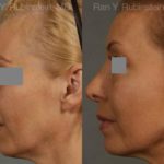 Rhinoplasty Before and After Photos in Montvale, NJ, Patient 13108
