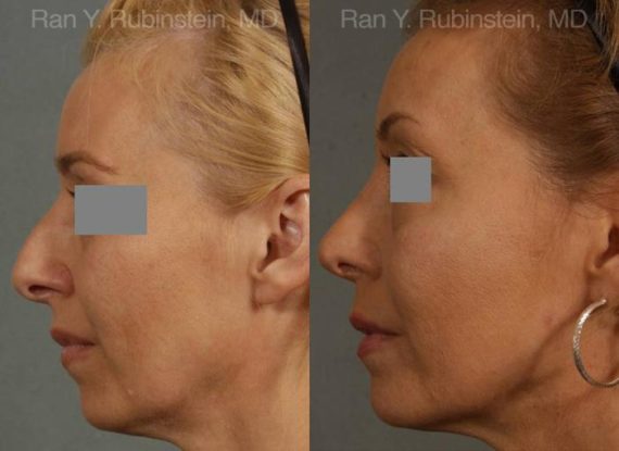 Rhinoplasty Before and After Photos in Montvale, NJ, Patient 13108
