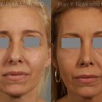 Rhinoplasty Before and After Photos in Montvale, NJ, Patient 13108