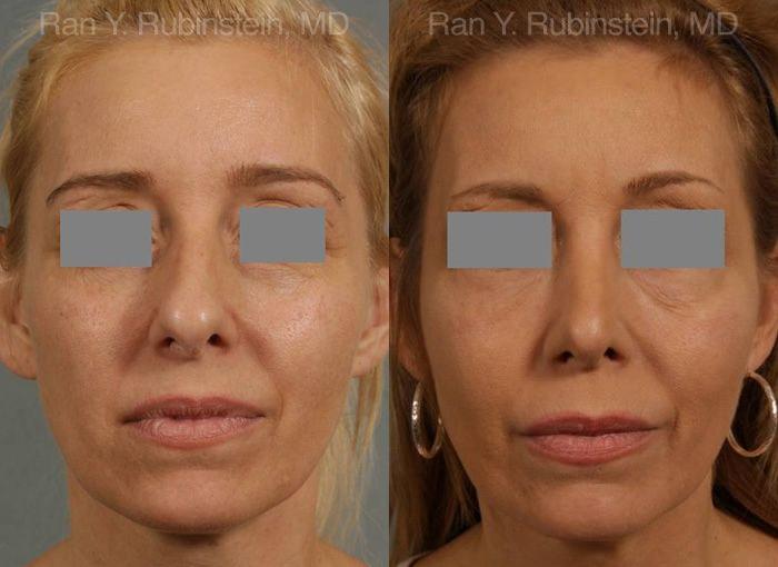 Rhinoplasty Before and After Photos in Montvale, NJ, Patient 13108