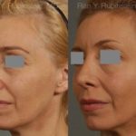 Rhinoplasty Before and After Photos in Montvale, NJ, Patient 13108