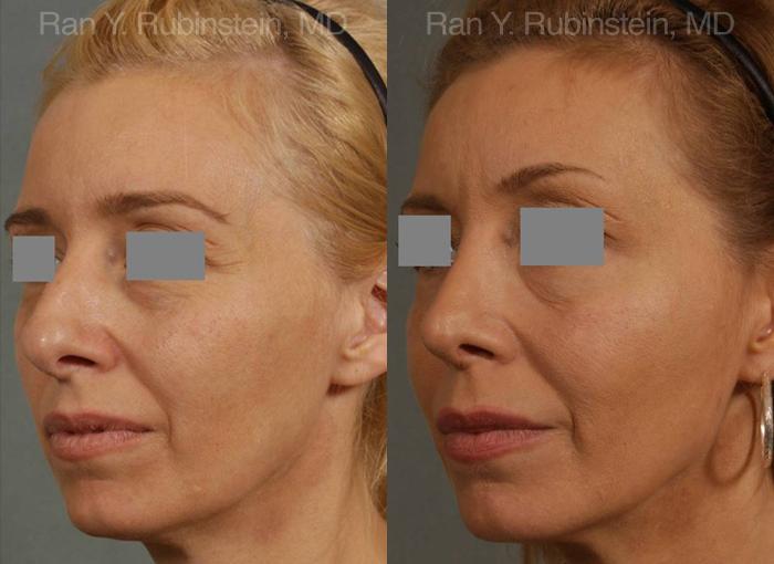 Rhinoplasty Before and After Photos in Montvale, NJ, Patient 13108
