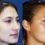 Rhinoplasty Before and After Photos in Montvale, NJ, Patient 13115