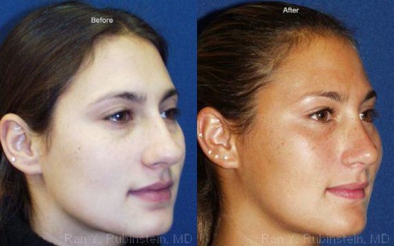 Rhinoplasty Before and After Photos in Montvale, NJ, Patient 13115