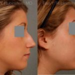 Rhinoplasty Before and After Photos in Montvale, NJ, Patient 13118