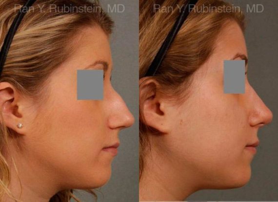 Rhinoplasty Before and After Photos in Montvale, NJ, Patient 13118