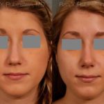 Rhinoplasty Before and After Photos in Montvale, NJ, Patient 13118