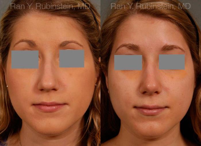 Rhinoplasty Before and After Photos in Montvale, NJ, Patient 13118