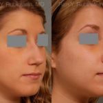 Rhinoplasty Before and After Photos in Montvale, NJ, Patient 13118