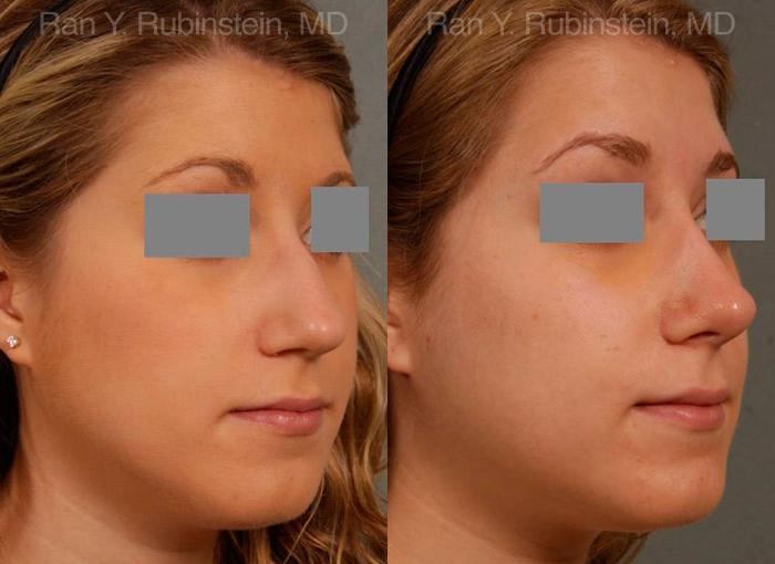 Rhinoplasty Before and After Photos in Montvale, NJ, Patient 13118
