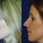 Rhinoplasty Before and After Photos in Montvale, NJ, Patient 13125