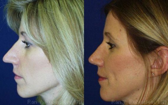 Rhinoplasty Before and After Photos in Montvale, NJ, Patient 13125