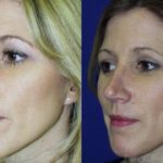 Rhinoplasty Before and After Photos in Montvale, NJ, Patient 13125