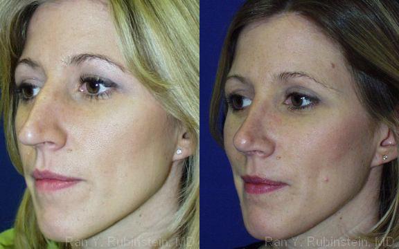 Rhinoplasty Before and After Photos in Montvale, NJ, Patient 13125
