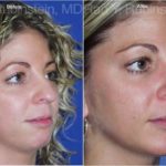 Rhinoplasty Before and After Photos in Montvale, NJ, Patient 13130