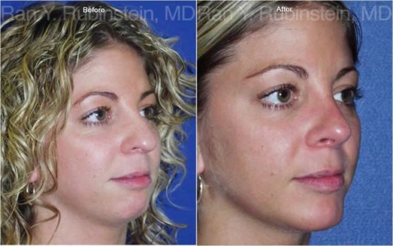Rhinoplasty Before and After Photos in Montvale, NJ, Patient 13130