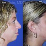 Rhinoplasty Before and After Photos in Montvale, NJ, Patient 13130