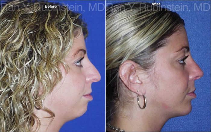 Rhinoplasty Before and After Photos in Montvale, NJ, Patient 13130