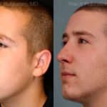 Rhinoplasty Before and After Photos in Montvale, NJ, Patient 13150