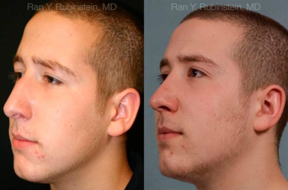 Rhinoplasty Before and After Photos in Montvale, NJ, Patient 13150