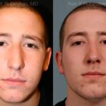 Rhinoplasty Before and After Photos in Montvale, NJ, Patient 13150