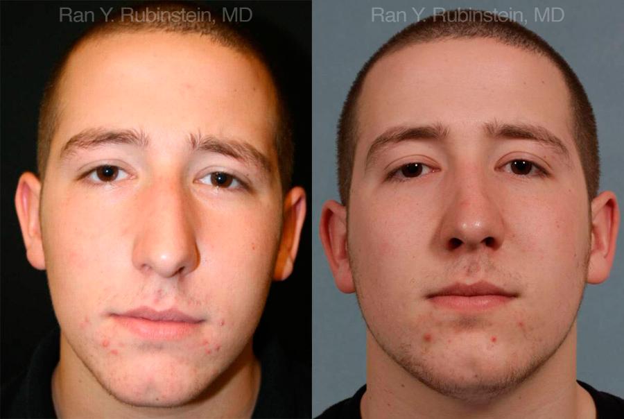 Rhinoplasty Before and After Photos in Montvale, NJ, Patient 13150