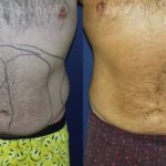 Smart Lipo Body Before and After Photos in Montvale, NJ, Patient 13210
