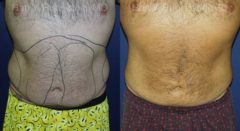 Smart Lipo Body Before and After Photos in Montvale, NJ, Patient 13210