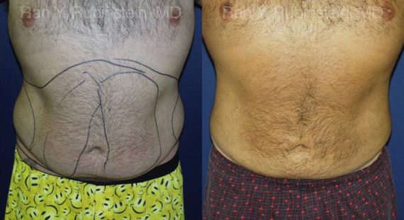 Smart Lipo Body Before and After Photos in Montvale, NJ, Patient 13210